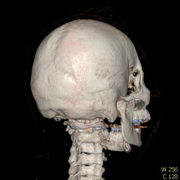 Polytrauma lebka S023 I0017.jpg