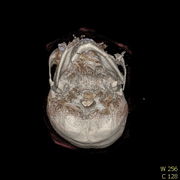 Polytrauma lebka S023 I0019.jpg