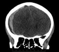 CT subdurální hematom dvoudobý, vpravo
