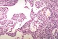 3. Negranulomatózní intersticiální pneumonie/alveolitida. Šipky ukazují malé kolekce makrofágů. Formace časného granulomu.