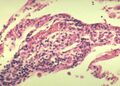 4. Negranulomatózní intersticiální pneumonie/alveolitida. Malé kolekce makrofágů. Formace časného granulomu.