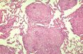 13. Formované, zralé granulomy bez známek předchozí negranulomatózní intersticiální alveolitidy.