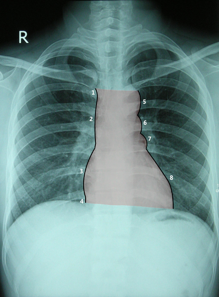 1. v. brachiocephalica dextra, 2. v. cava superior, 3. atrium dextrum, 4. v. cava inferior, 5. arcus aortae, 6. truncus pulmonalis (společně s a. pulmonalis sinistra), 7. auricula sinistra, 8. ventriculus sinister