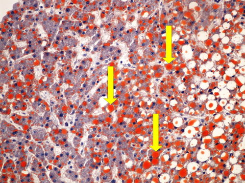 Z1-10 lipid staining (liver) prukaz tuku (jatra) 20x oznaceno.jpg