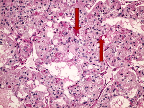 Z1-8 PAS (clear cell renal cell carcinoma) PAS (Grawitzuv ca) 20x oznaceno.jpg