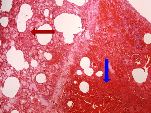 Z2-5 hemorrhagic necrosis lung hemoragicka nekroza plice 4x oznaceno.jpg
