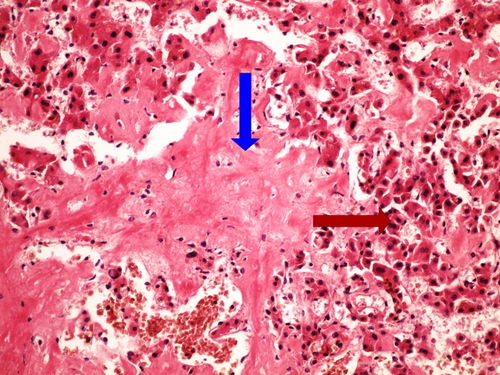 Z3-13 amyloidosis liver amyloidoza jater HE 20x oznaceno.jpg