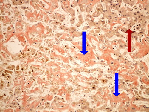 Z3-13 amyloidosis liver amyloidoza jater kongo 20x oznaceno.jpg