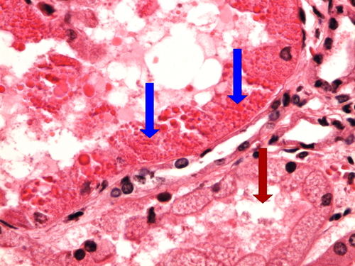 Z3-2 hyaline dropplets kidney hyalinni zkapenkovateniledviny 60x oznaceno.jpg