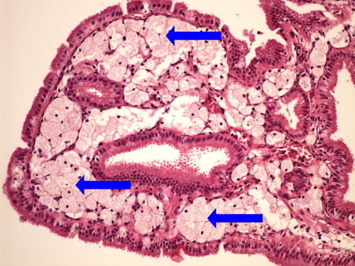 Z3-7 gallbladder cholesterolosis cholesterolosa zlucniku 20x oznaceno.jpg