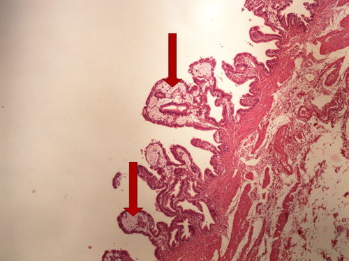 Z3-7 gallbladder cholesterolosis cholesterolosa zlucniku 4x 1 oznaceno.jpg