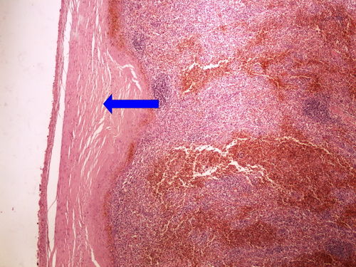 Z3-8 perisplenitis cartilaginea 4x oznaceno.jpg
