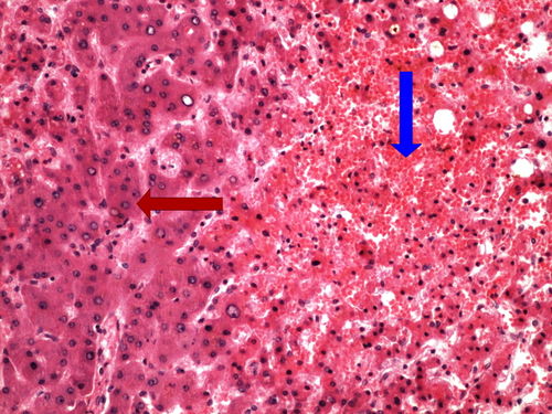 Z5-3 nutmeg liver chronicka venostaza jater 20x oznaceno.jpg