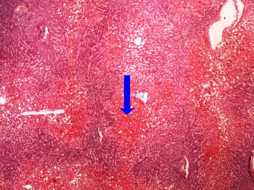 Z5-3 nutmeg liver chronicka venostaza jater 4x oznaceno.jpg