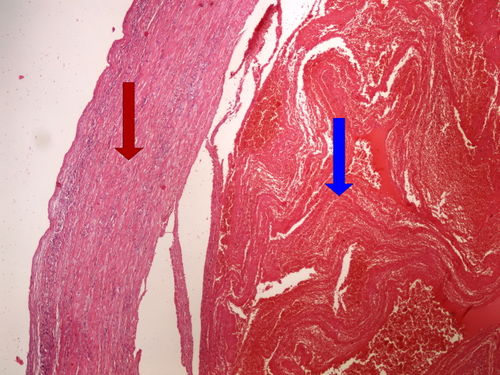 Z5-4 acute thrombosis cerstva tromboza 4x oznaceno.jpg
