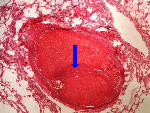 Z5-8 lung trombotic emboly tromboticka embolie plicnice 4x oznaceno.jpg