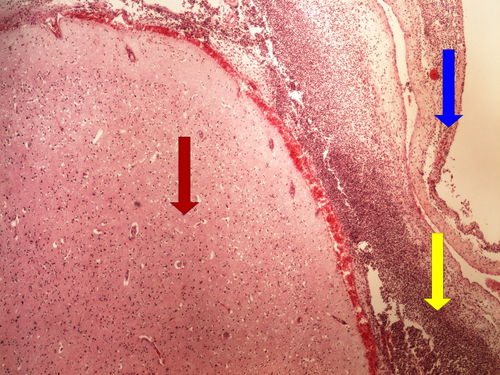 Z6-2 purulent meningitis hnisava leptomeningitida 4x oznaceno.jpg