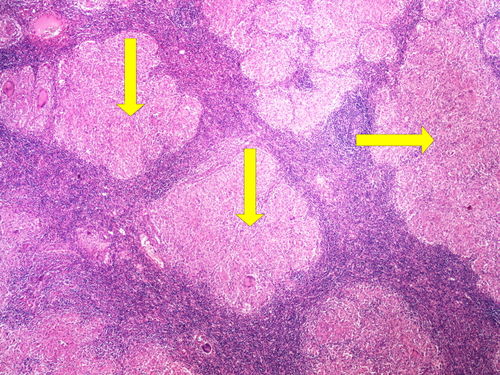 Z7-10 sarcoidosis sarkoidoza 4x oznaceno.jpg