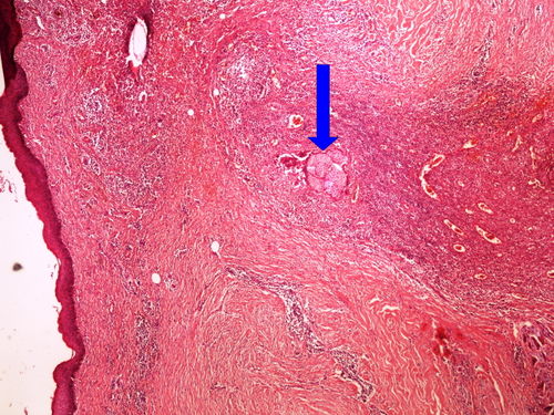 Z7-1 foreighn body granuloma obrovskobunecny granulom 4x oznaceno.jpg