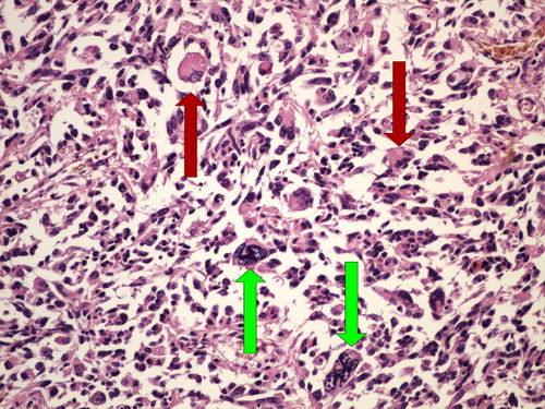 Z 8-18 pleomorphic sarcoma polymorfocelularni sarkom 20x oznaceno.jpg