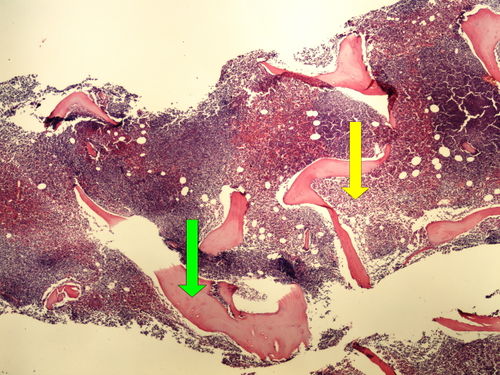 Z 9-13 CLL bone marrow infiltrace kostni drene pri CLL 4x oznaceno.jpg