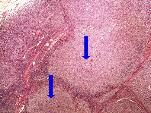 Z 9-2 follicular lymphoma 4x oznaceno.jpg