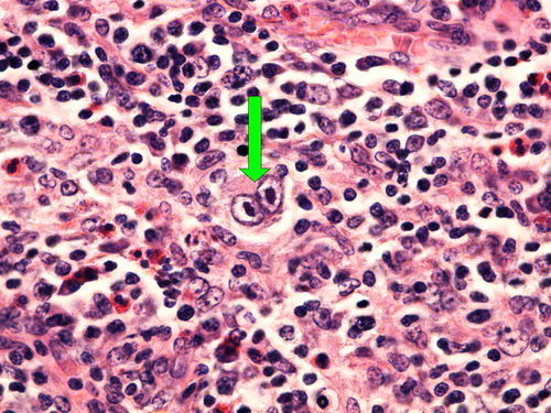 Z 9-8 classic Hodgkin lymphomad mixed cellularity klasicky Hodgkinuv lymfom smisena celularita 60x oznaceno.jpg